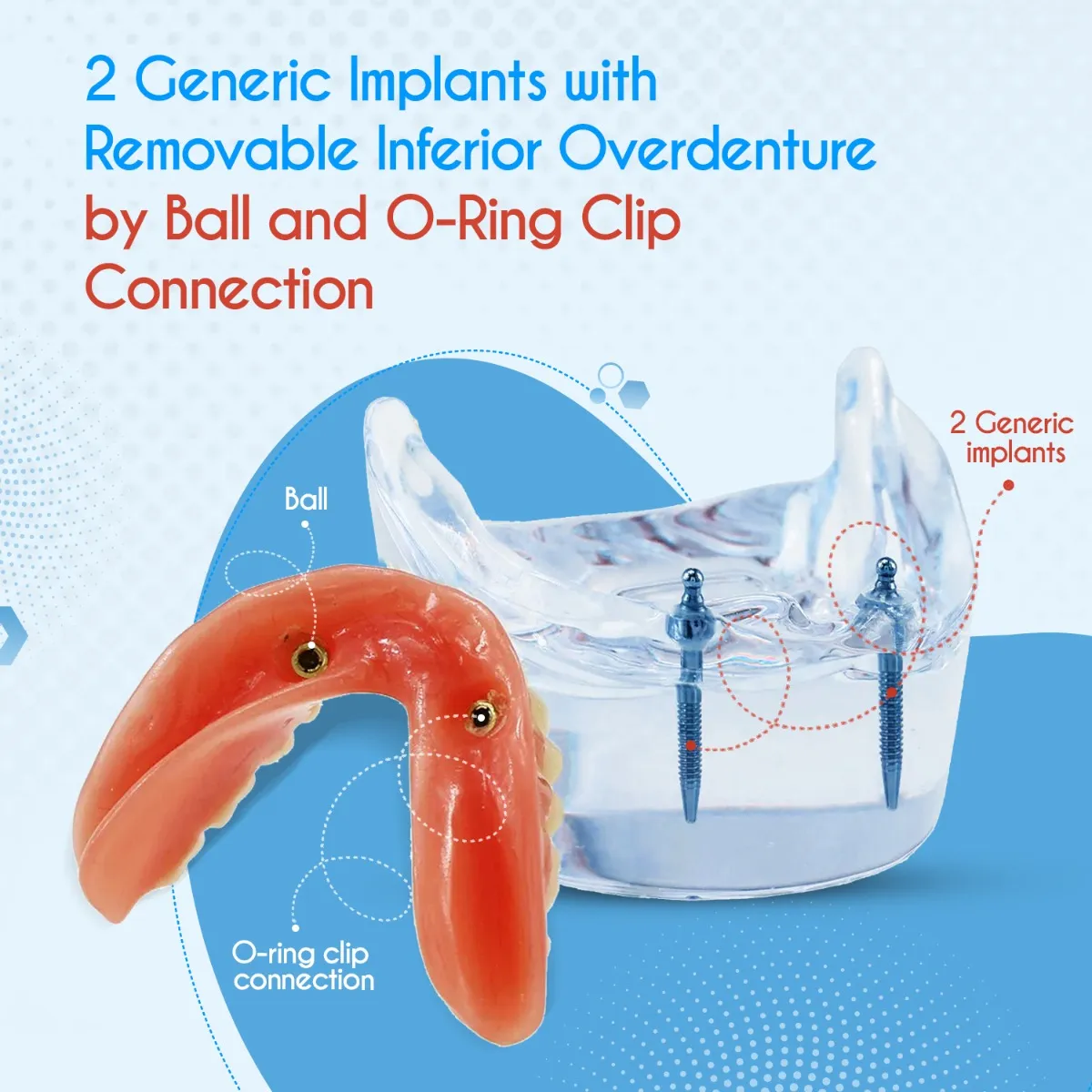 O-ring retained maxillary overdenture. (A) Ball abutments screwed in... |  Download Scientific Diagram